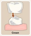 dental_crowns