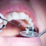 dental_fillings-150x150