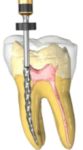 dental_root_canal