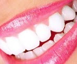 dental_veneers-150x126