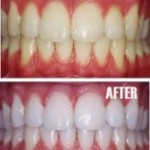dental_whitening-150x150