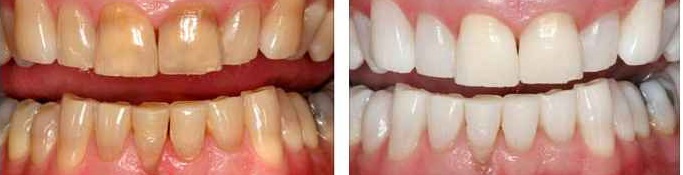 Dental Whitening Before and After