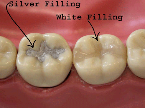 white fillings  AC Dental of Hackensack & Paramus