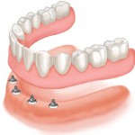 Dentures Over Implants