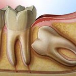 Wisdom Tooth