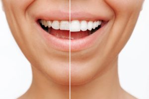 Dental Veneers Paramus, NJ at AC Dental